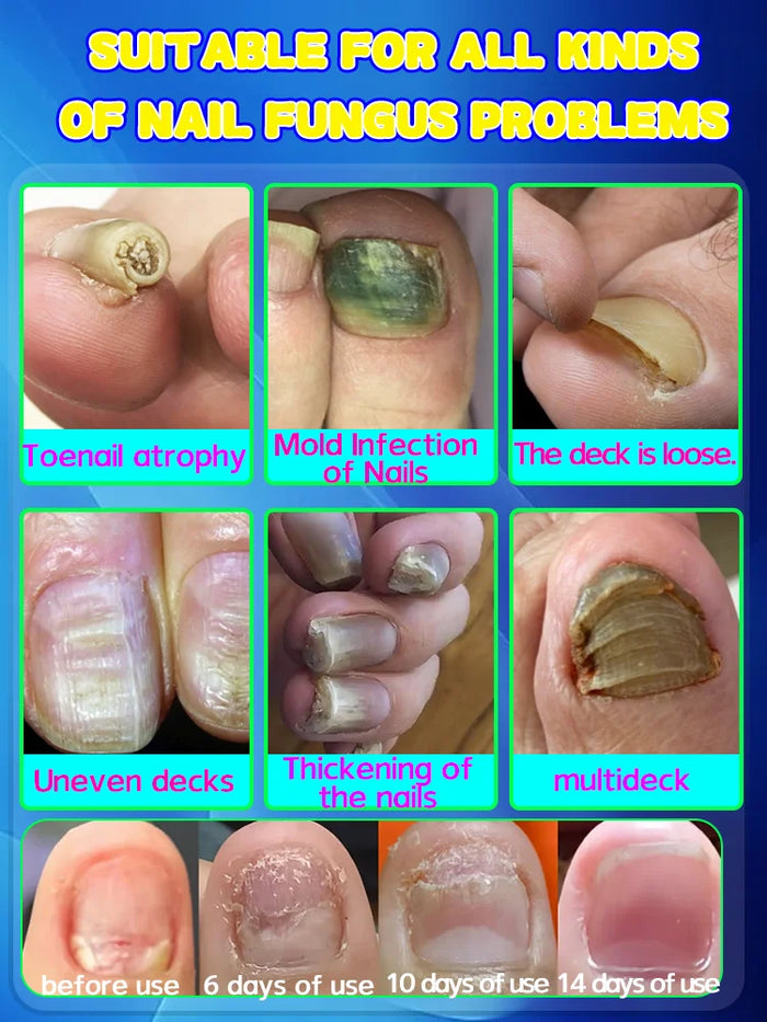 Anti-mold and anti-bacterial technology, restoring nails to their natural shine