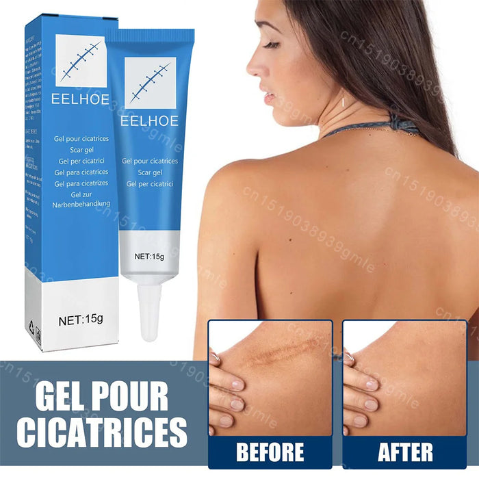 Recovery Scar Cream Fast Removal Skin Scars Treat Surgery Scars Stretch Marks Acne Pox Prints Burn Repair Facial Care Gel