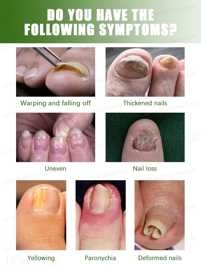 Quickly eliminate fungus and restore healthy nails